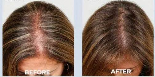 nileora GrowLux Laser Cap