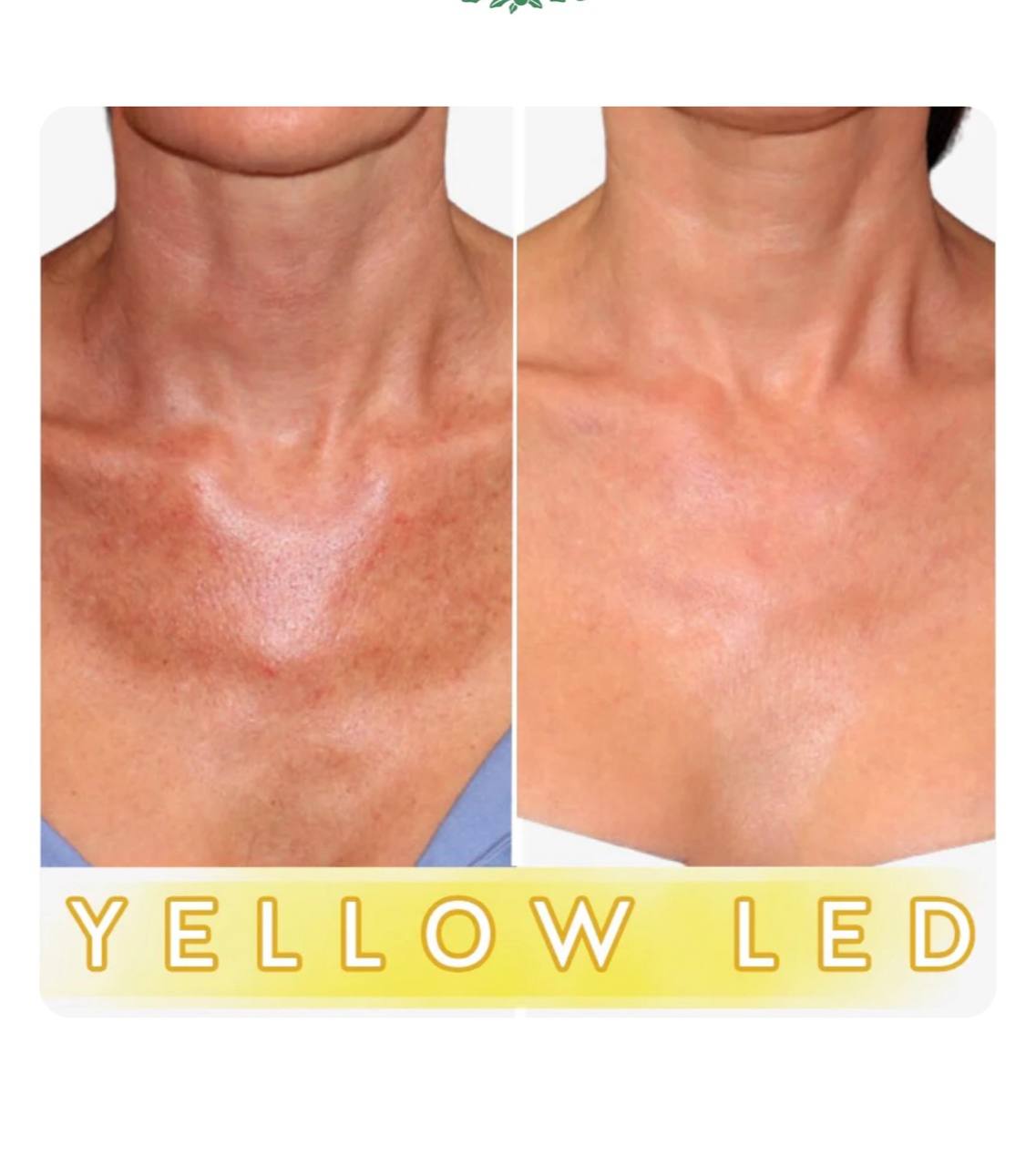 Neck & Chest Pro Light Therapy Mask