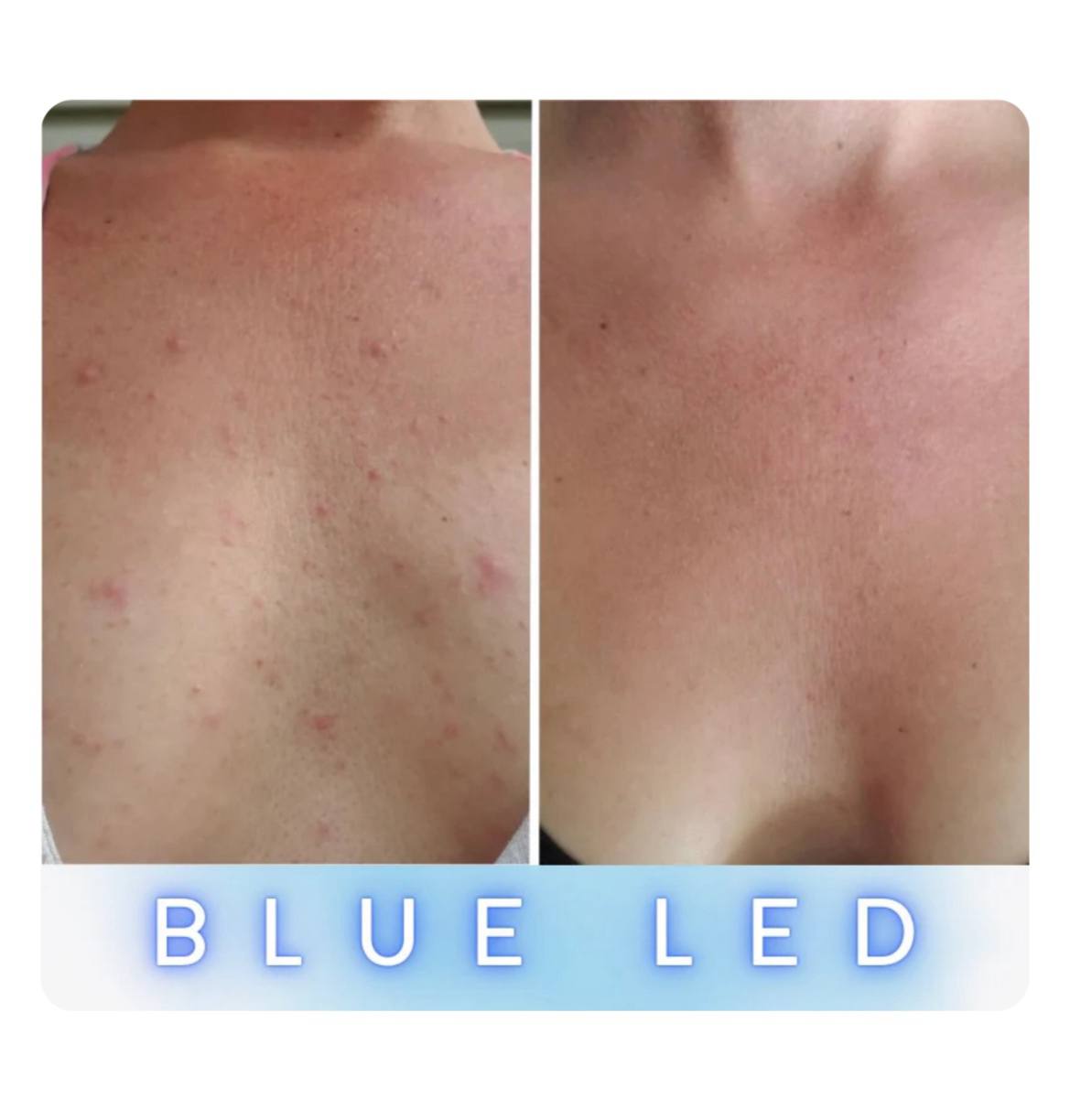 Neck & Chest Pro Light Therapy Mask