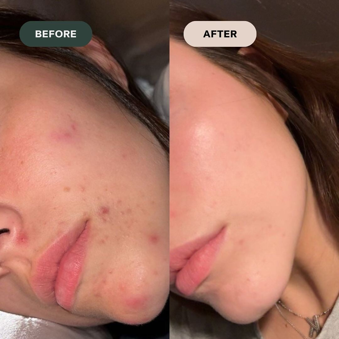 Nileora Red Light Therapy Wand