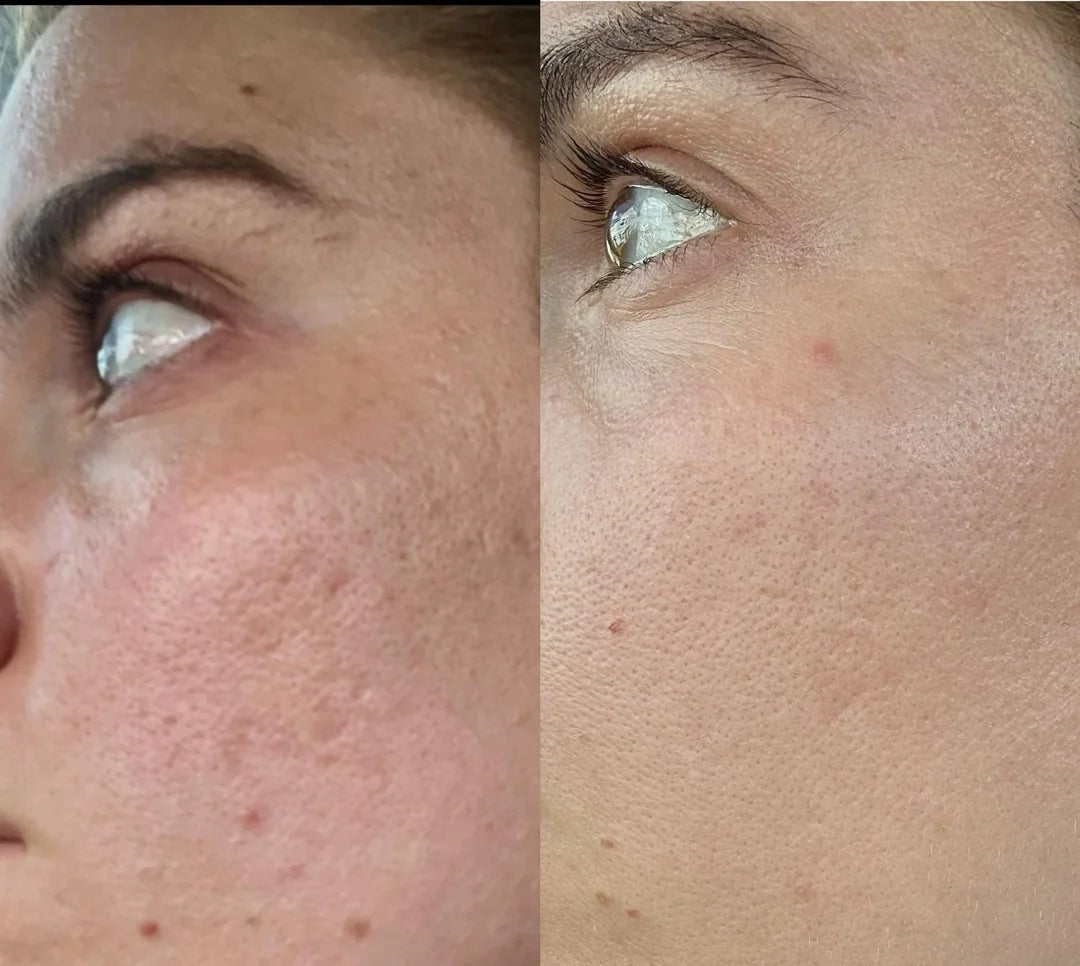 nileora Lux LASER Light Therapy Mask