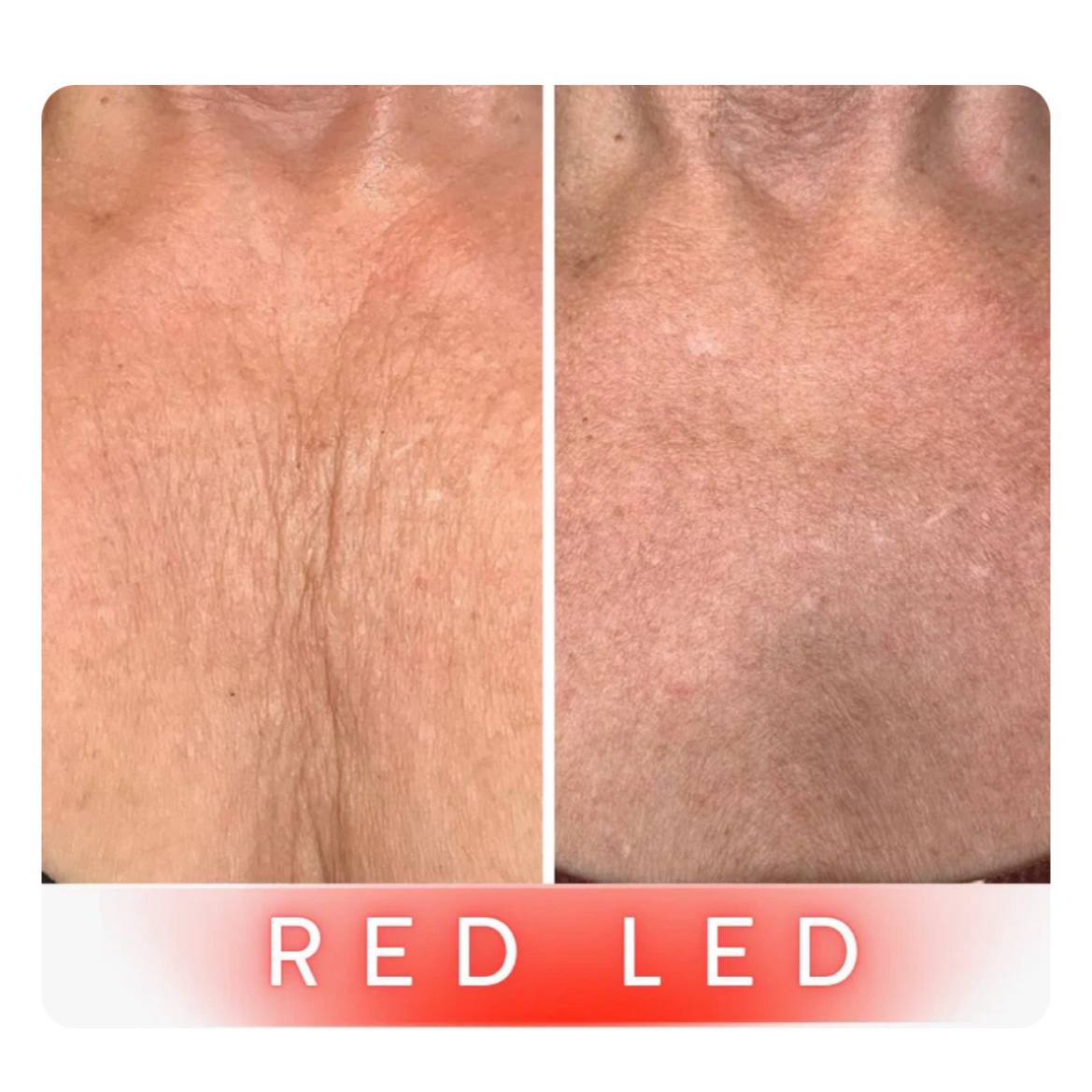 Neck &amp; Chest Pro Light Therapy Mask