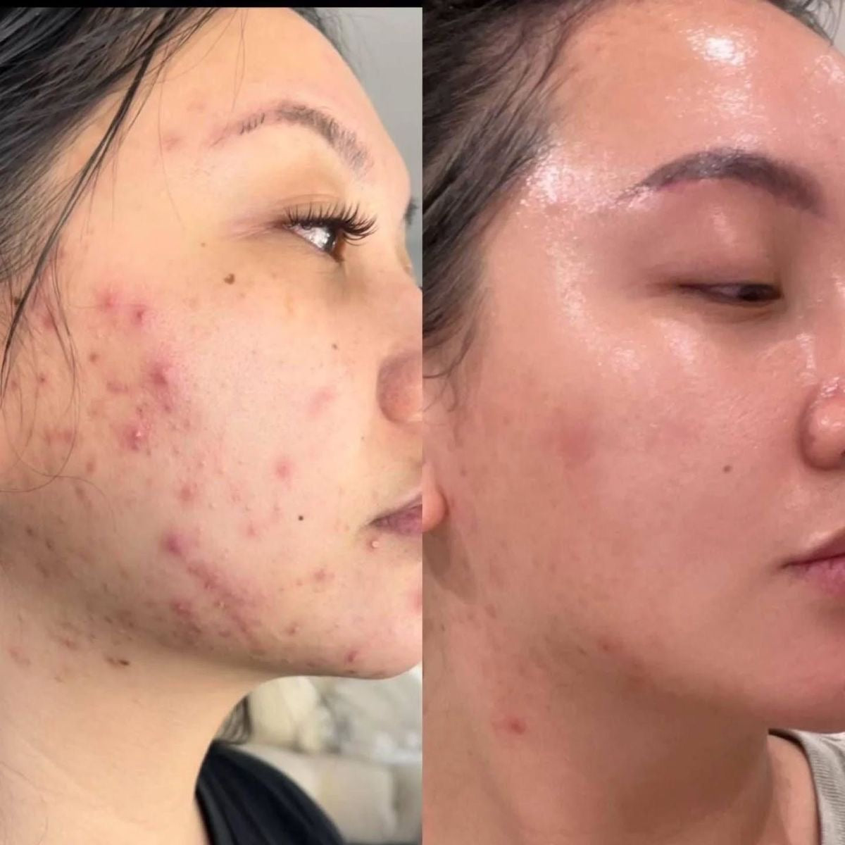 Nileora LED Red Light Therapy Face Mask