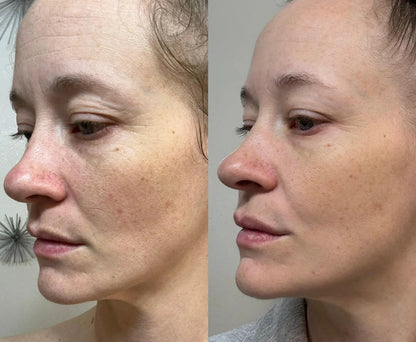 nileora Lux LASER  Light Therapy Mask